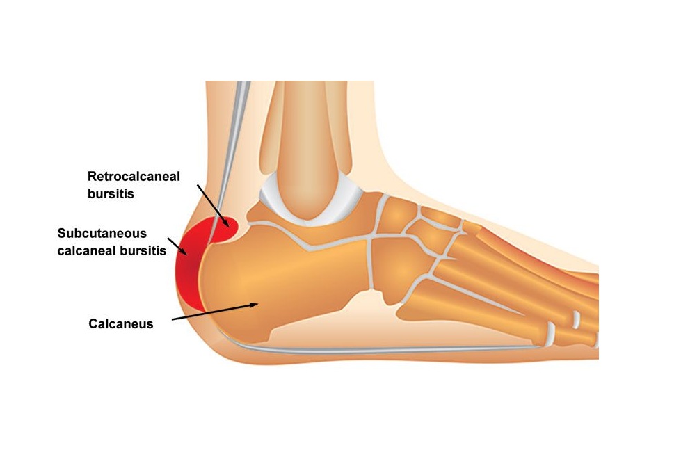 retrocalcaneal